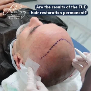 fue hair restoration Dublin
