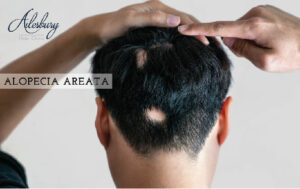 alopecia areata in men From dublin