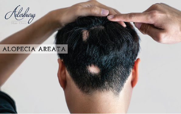 alopecia areata in men From dublin