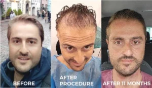hair transplant before after in dublin ireland