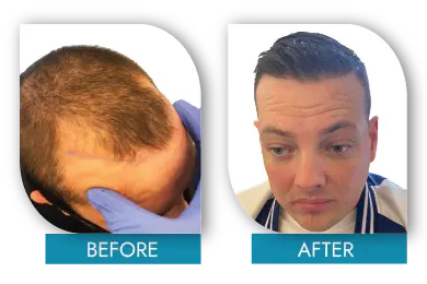 Hair loss before and after results in Dublin showing natural regrowth