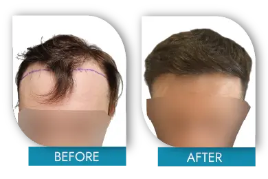 Men’s hair restoration before and after in Dublin clinic