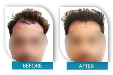 hair loss treatment before and after Dublin results