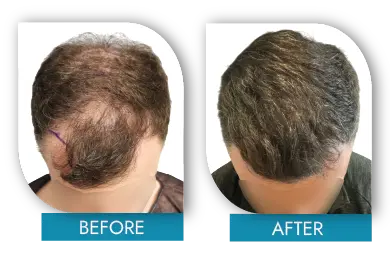 Hair density improvement before and after Dublin procedure
