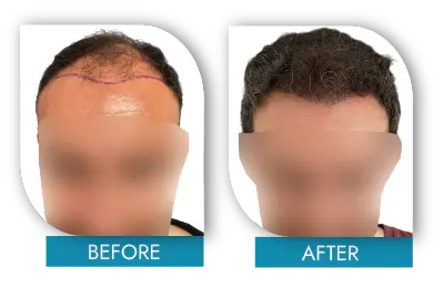 Receding hairline before and after results in Dublin Ireland