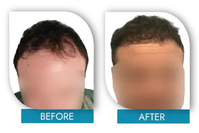 Hair transplant before and after Dublin transformation