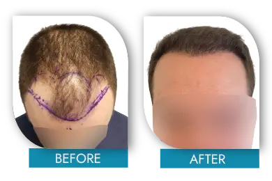 Hair regrowth journey before and after in Dublin treatment center