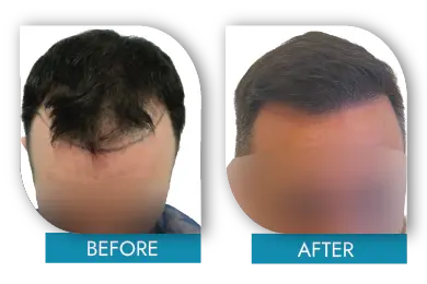 Bald spot correction before and after results in Dublin