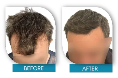 Natural hairline design before and after Dublin hair restoration