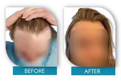 FUE hair transplant before and after results in Dublin clinic