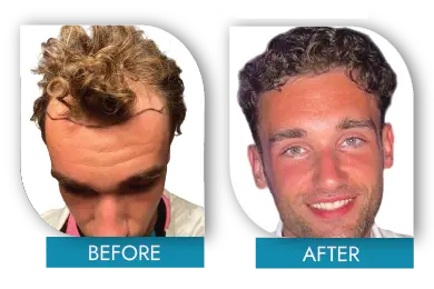 hair restoration before and after results in Dublin clinic