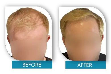 Hair transplant before and after results in Dublin with natural density