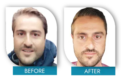 Hairline restoration before and after Dublin procedure results
