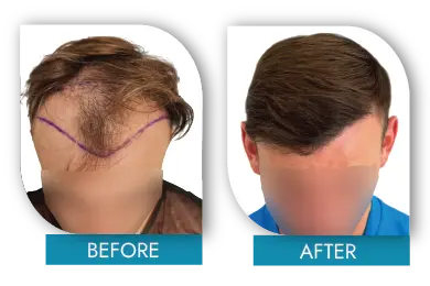 Crown hair loss before and after results from Dublin clinic