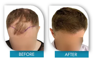 Early stage hair loss before and after improvement in Dublin