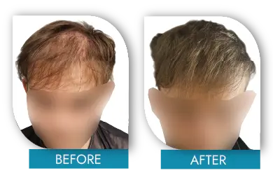 Advanced baldness before and after hair transplant Dublin results