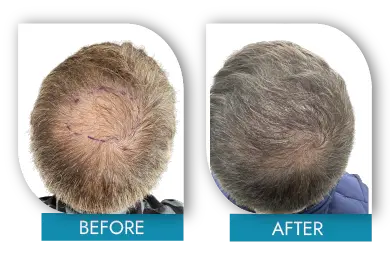 Hair loss recovery before and after Dublin advanced treatment