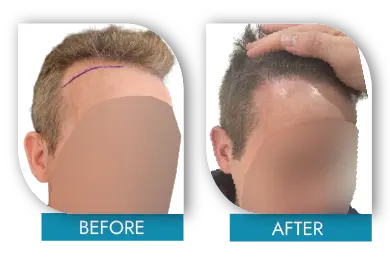 Patchy hair loss before and after treatment results Dublin