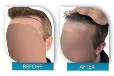 Hair restoration success story before and after Dublin Ireland