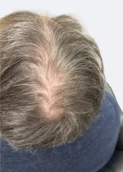 Patient Before Non-Surgical Laser Programs in Dublin