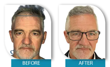 Dublin hair transplant before and after transformation for male patient
