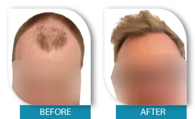 Dublin clinic hair transplant results showing thick and fuller hair