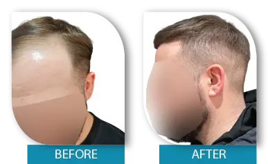 Visible hair regrowth before and after treatment in Dublin clinic