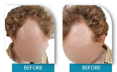 Noticeable hair regrowth before and after Dublin hair restoration clinic