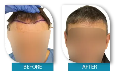 Temple hair restoration before and after Dublin clinic results