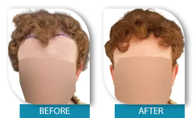 Diffuse hair thinning before and after treatment results in Dublin
