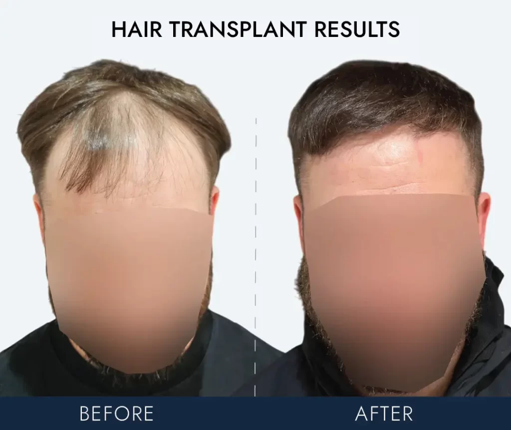 Hair Transplant Cost in Ireland start from €2,000 to €3,500