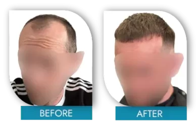 Natural-looking hair transplant before and after in Dublin Ireland